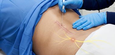 Radiofrequency Ablation